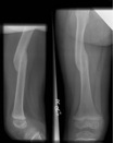 Paediatric Femur Fracture 2 month